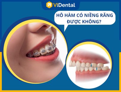 [Giải Đáp] Hô Hàm Có Niềng Răng Được Không? Chi Phí Có Đắt Không?