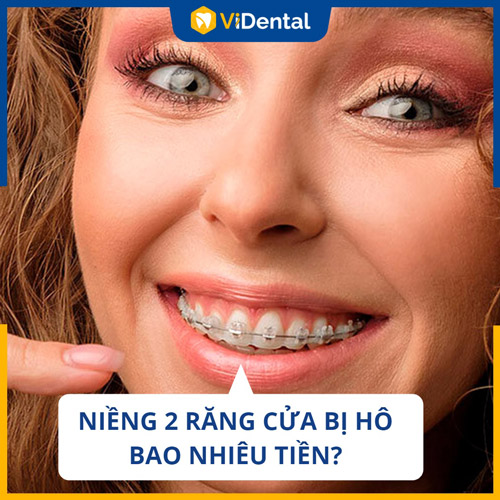 Chi phí niềng 2 răng cửa bị hô bao nhiêu tiền là thắc mắc của nhiều người