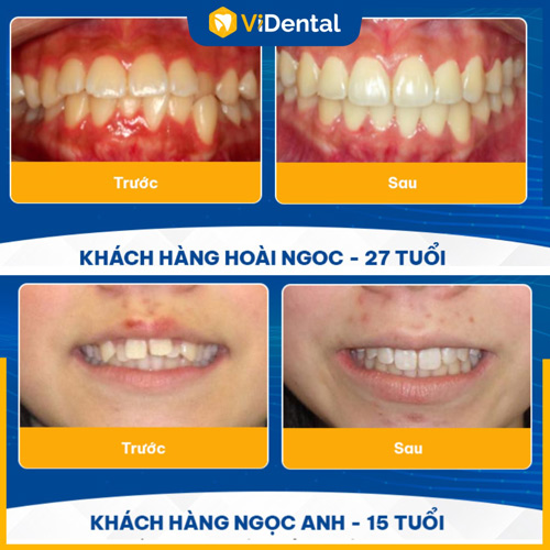 Kết quả niềng răng cửa bị hô thành công mỹ mãn của khách hàng ViDental