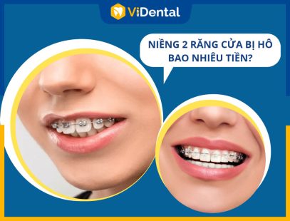 [CHI TIẾT BẢNG GIÁ] Niềng 2 Răng Cửa Bị Hô Bao Nhiêu Tiền?