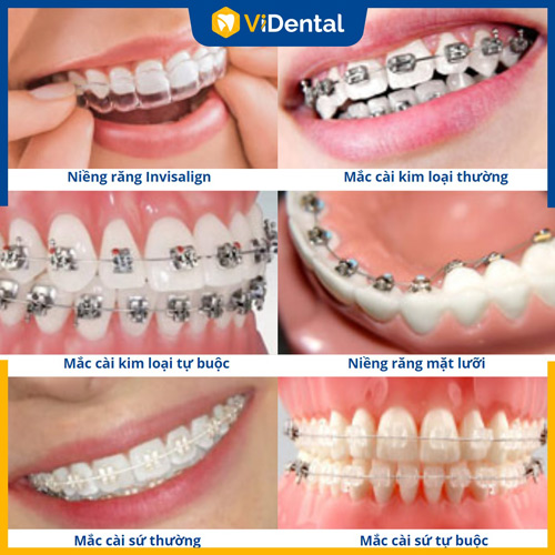 Các phương pháp niềng răng tại ViDental Brace