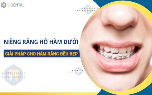 Niềng Răng Hô Hàm Dưới: Chi Tiết Phương Pháp, Bảng Giá