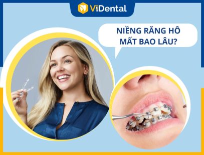 Niềng Răng Hô Mất Bao Lâu? Phương Pháp Nào Chỉnh Nha Nhanh Nhất?