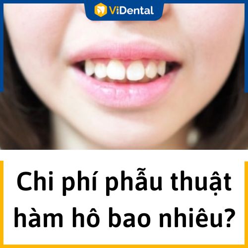 Chi tiết chi phí phẫu thuật hàm hô tương đối cao