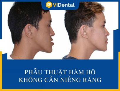 Phẫu Thuật Hàm Hô Không Cần Niềng Răng: TẤT TẦN TẬT Thông Tin