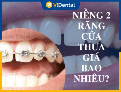 Niềng 2 Răng Cửa Thưa Giá Bao Nhiêu? Bảng Giá Mới Nhất