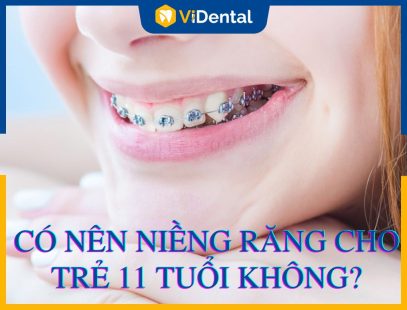 Niềng Răng Cho Trẻ 11 Tuổi: Phương Pháp Thực Hiện, Bảng Giá