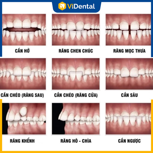 Trường hợp hô, móm, khấp khểnh,... đều nên niềng răng