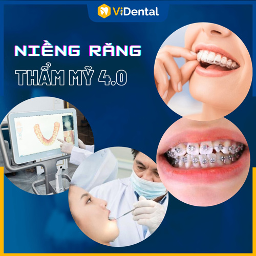 Niềng răng theo công nghệ hiện đại mang lại nhiều lợi ích