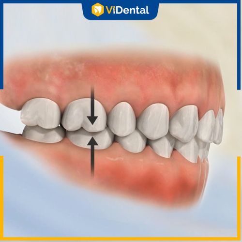 Mặt lệch có thể do nguyên nhân là lệch khớp cắn