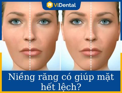 Niềng Răng Có Giúp Mặt Hết Lệch Không - Chuyên Gia Giải Đáp