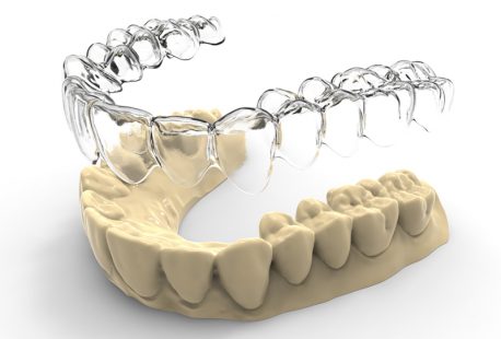 Kỹ thuật niềng răng Ecligner tiến tiến hiện đại