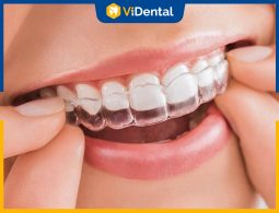 Niềng Răng Invisalign Có Đau Không? Lưu Ý Để Niềng Không Đau