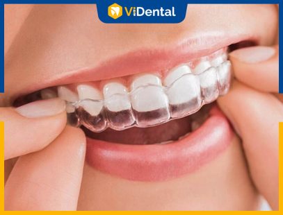 Niềng Răng Invisalign Có Đau Không? Lưu Ý Để Niềng Không Đau