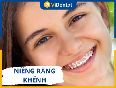 Niềng Răng Khểnh: Hiệu Quả, Phương Pháp, Chi Phí Thực Hiện