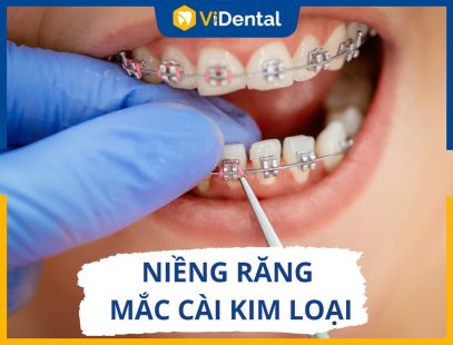 Niềng Răng Mắc Cài Kim Loại - Phương Pháp Hiệu Quả Nhất