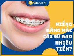 Bảng giá niềng răng mắc cài sứ tại ViDental Brace