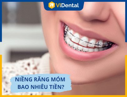 Niềng Răng Móm Bao Nhiêu Tiền? Cập Nhật Bảng Giá Mới Nhất