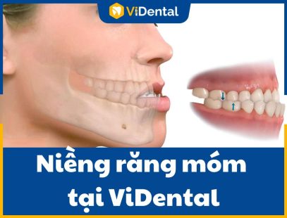 Niềng Răng Móm tại ViDental Brace - Kết Quả TỐI ƯU, Tiết Kiệm Chi Phí