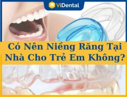 Có Nên Niềng Răng Tại Nhà Cho Trẻ Em Không? Phương Pháp