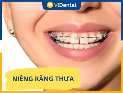 Niềng Răng Thưa - Giải Pháp Tối Ưu Giúp Sở Hữu Nụ Cười Tự Tin