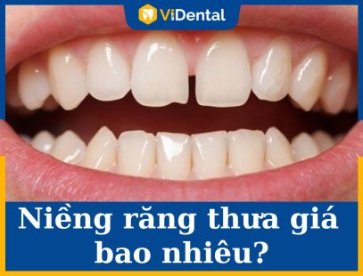 Niềng Răng Thưa Bao Nhiêu Tiền - [Bảng Giá Mới Nhất]