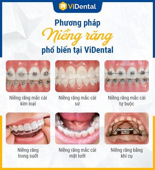 Vidental có đầy đủ phương pháp niềng răng 