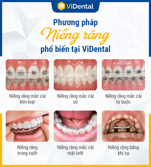 tại ViDental Brace có nhiều gói trả góp với đa dạng phương pháp niềng răng