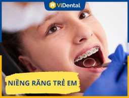 Bảng Giá Niềng Răng Trẻ Em Và Địa Chỉ Thực Hiện Uy Tín Nhất