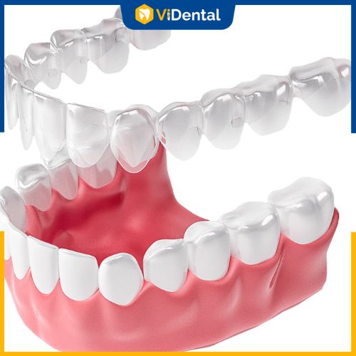 Nhược điểm của niềng răng trong suốt Clear Aligner là chi phí cao 