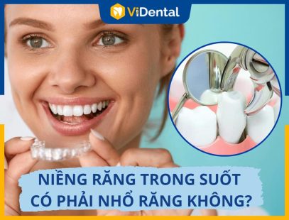 Niềng Răng Trong Suốt Có Phải Nhổ Răng Không? [Chi Tiết Nhất]