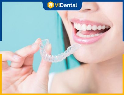 Niềng Răng Invisalign Giá Bao Nhiêu Tiền