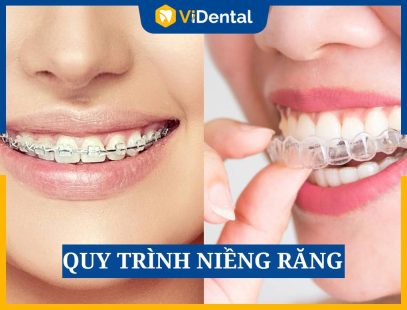 [Giải Đáp] Quy Trình Niềng Răng Chi Tiết Ra Sao? Cần Lưu Ý Gì?