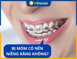 [Giải Đáp] Bị Móm Có Nên Niềng Răng? Có Hiệu Quả Thật Không?