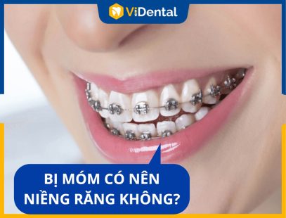 [Giải Đáp] Bị Móm Có Nên Niềng Răng? Có Hiệu Quả Thật Không?