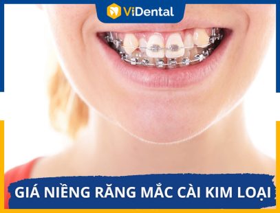 Bảng giá niềng răng mắc cài kim loại tại ViDental Brace