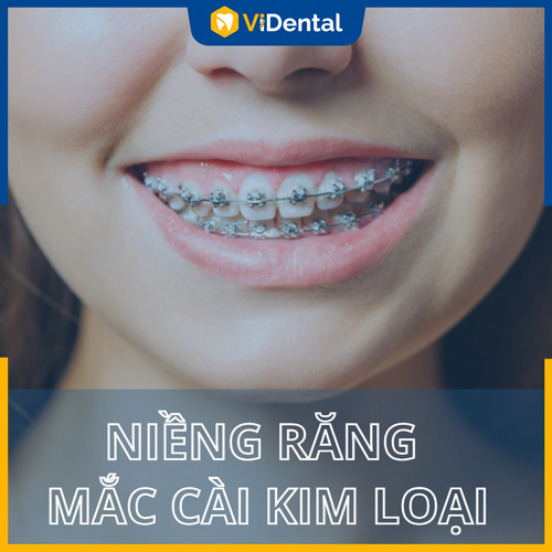 Giá niềng răng mắc cài kim loại ảnh hưởng bởi nhiều yếu tốc