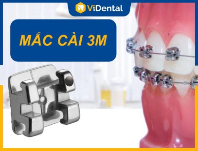 Niềng Răng Mắc Cài 3M Là Gì? Ưu, Nhược Điểm, Chi Phí Ra Sao