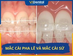 Phân Biệt 2 Loại Niềng Răng Mắc Cài Pha Lê Và Mắc Cài Sứ