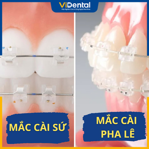 Mắc cài pha lê và mắc cài sứ ngày càng được ưa chuộng