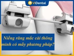 Niềng Răng Mắc Cài Thông Minh Có Mấy Phương Pháp, Bảng Giá