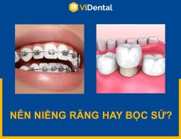 Nên Niềng Răng Hay Bọc Sứ Để Khắc Phục Răng Lệch Lạc?