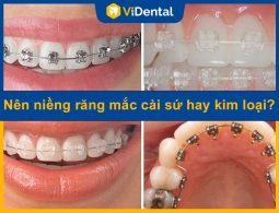 Nên Niềng Răng Mắc Cài Sứ Hay Kim Loại - Chuyên Gia Giải Đáp