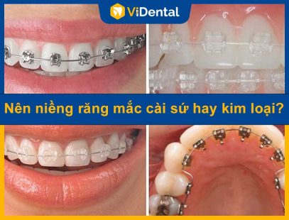 Nên Niềng Răng Mắc Cài Sứ Hay Kim Loại - Chuyên Gia Giải Đáp