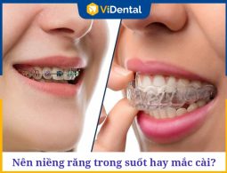 Nên Niềng Răng Trong Suốt Hay Mắc Cài - Cách Nào Tốt Nhất