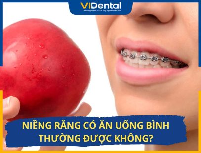 Niềng Răng Có Ăn Uống Bình Thường Được Không? Lưu Ý Gì?