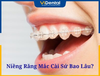 Niềng Răng Mắc Cài Sứ Bao Lâu Để Có Hàm Răng Đều Đẹp?