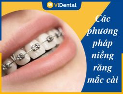 Niềng Răng Mắc Cài: Các Phương Pháp Và Quy Trình Chỉnh Nha