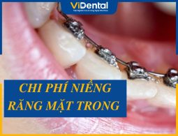 [XEM NGAY] Bảng Giá Niềng Răng Mặt Trong MỚI NHẤT