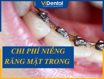 [XEM NGAY] Bảng Giá Niềng Răng Mặt Trong MỚI NHẤT